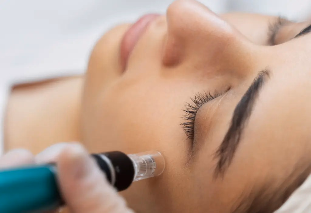 Microneedling bei JWC Kosmetik