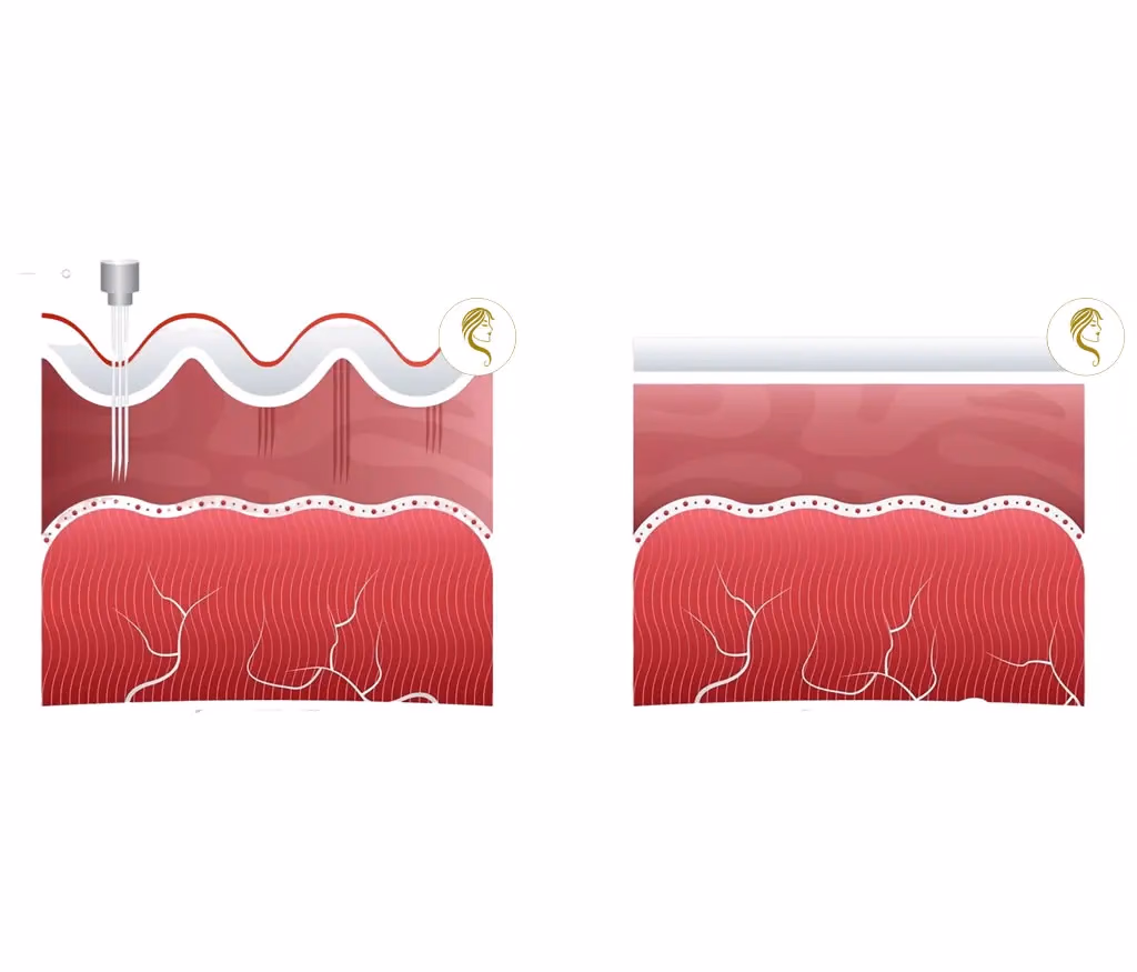 Ablauf des Microneedlings bei JWC Kosmetik
